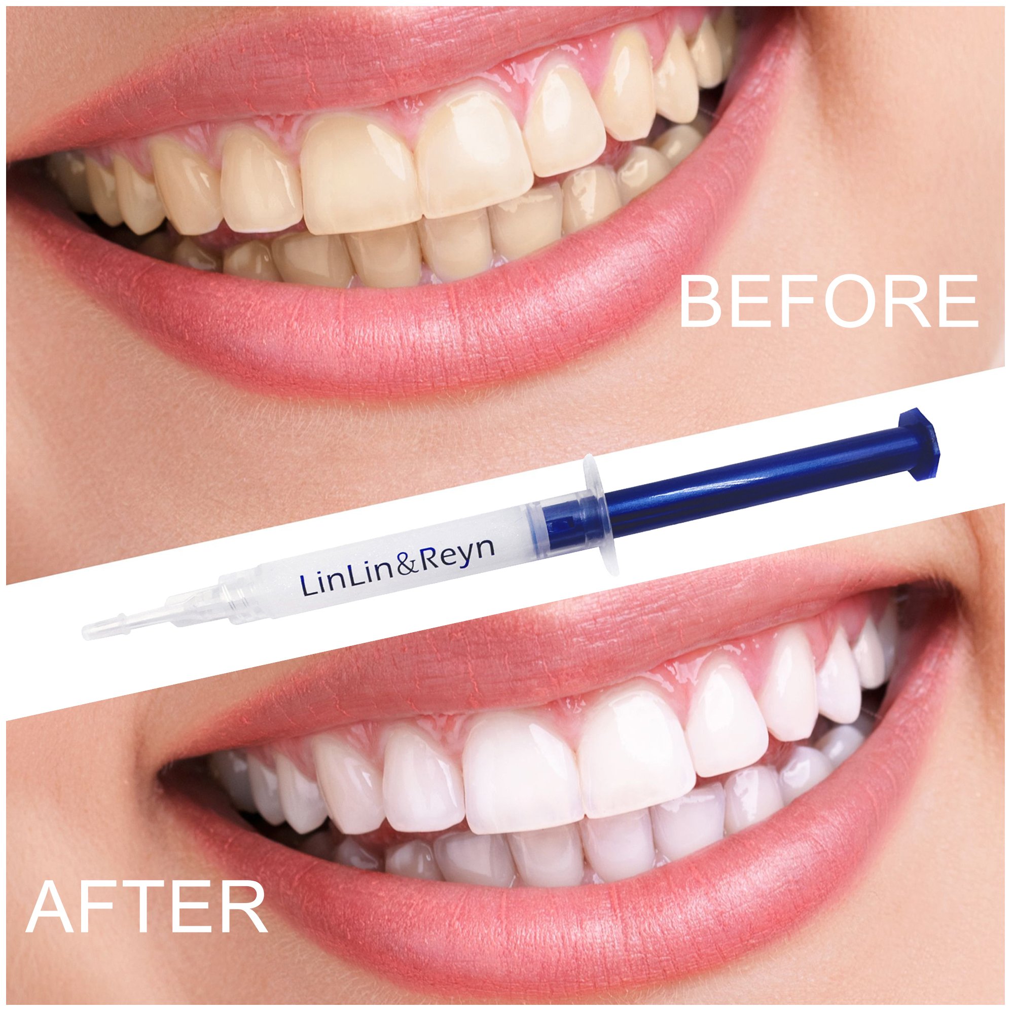 Teeth Whitening LED Light Accelerator – Gel Syringes