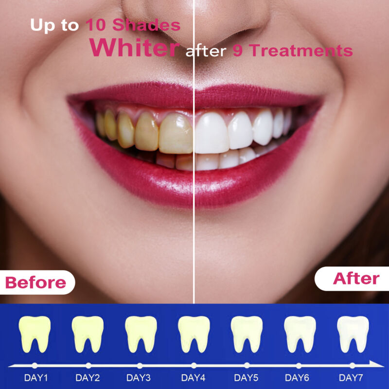 Teeth Whitening LED Kit – 10 Minute Treatment