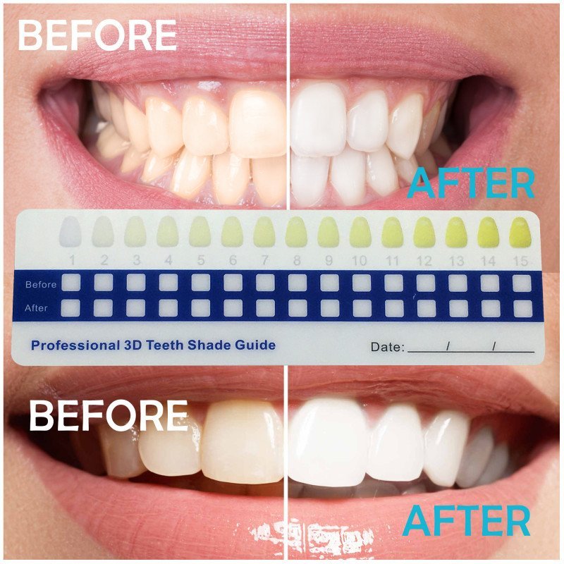 Teeth Whitening LED Light – 5 Bulbs